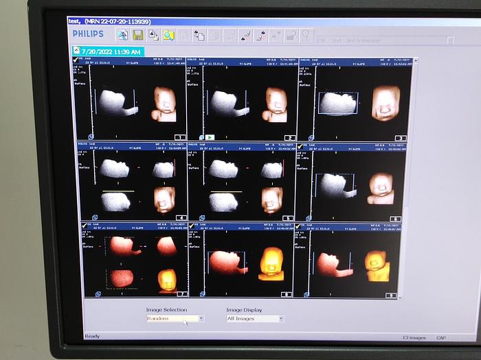 Gebraucht Philips HD 11xe 2197 Ultraschallgerät inkl. 3 Sonden und EKG Kabel