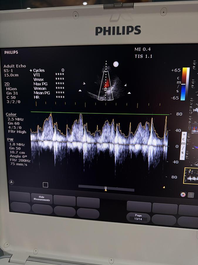 Gebraucht Philips CX50 Ultraschallgerät mit Sonde C.1