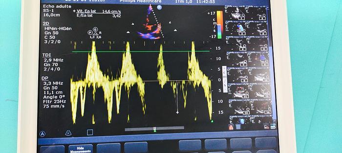 Gebraucht philips ultrasound cx50 mit 2 Sonde linear und sektor