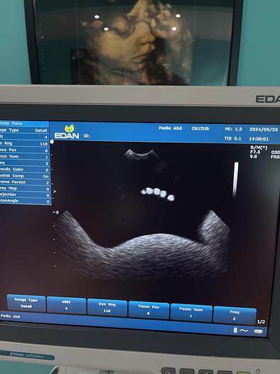 Used EDAN U2 Ultraschallgerät mit drei Sonden und Drucker