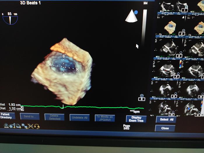 Gebraucht Philips iE33 Ultraschallgerät mit eine X5-1 Sonde