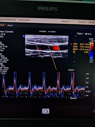 Gebraucht Philips L12-5 Linear Ultraschallsonde