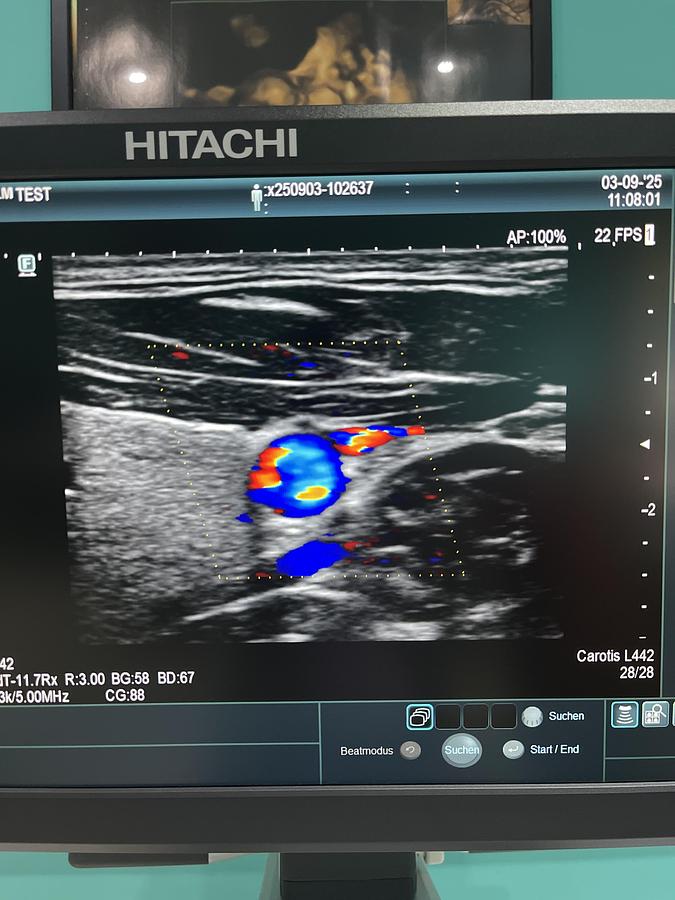 Gebraucht Hitachi ALOKA Arietta 65 Ultraschallgerät mit zwei Sonden