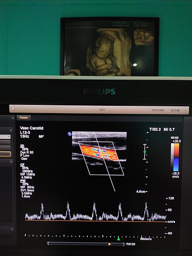 Gebraucht Ultraschallgerät Philips EPIQ 5