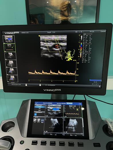 Used Vinno G55 Ultraschallgerät mit Konvex Sonde