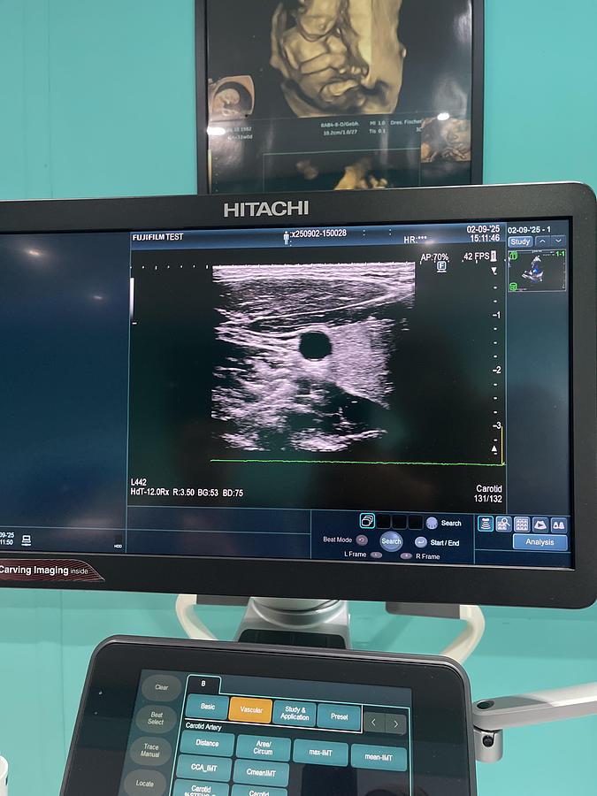 Gebraucht Hitachi ALOKA Arietta 850 Ultraschallgerät mit zwei Sonden und Drucker