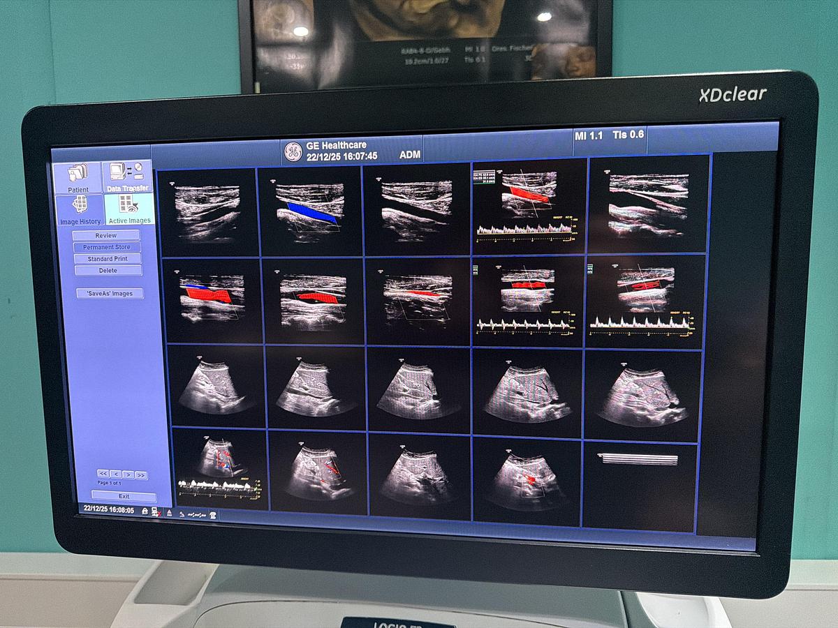 Gebraucht GE LOGIQ E9 XDClear Elastography Ultraschallgerät mit zwei Sonden  