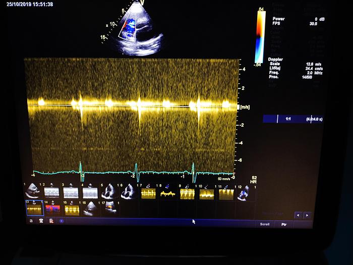 Gebraucht GE Vivid E9 Ultraschallgerät mit MS5-D Kardiosonde