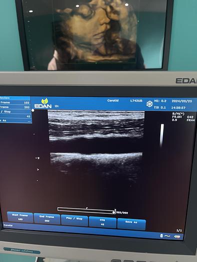 Used EDAN U2 Ultraschallgerät mit drei Sonden und Drucker