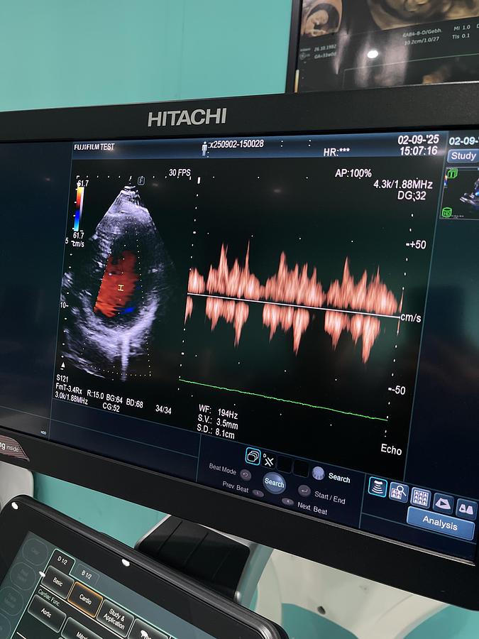 Gebraucht Hitachi ALOKA Arietta 850 Ultraschallgerät mit zwei Sonden und Drucker