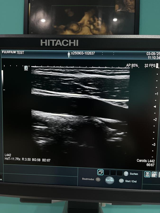 Gebraucht Hitachi ALOKA Arietta 65 Ultraschallgerät mit zwei Sonden