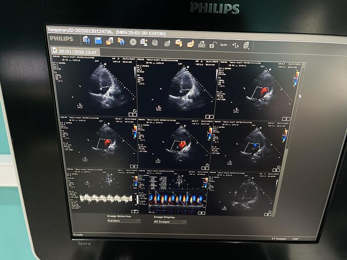 Gebraucht Philips Sparq Ultraschallgerät mit drei Sonden