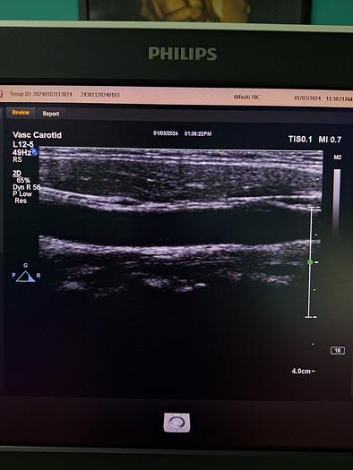 Gebraucht Philips L12-5 Linear Ultraschallsonde