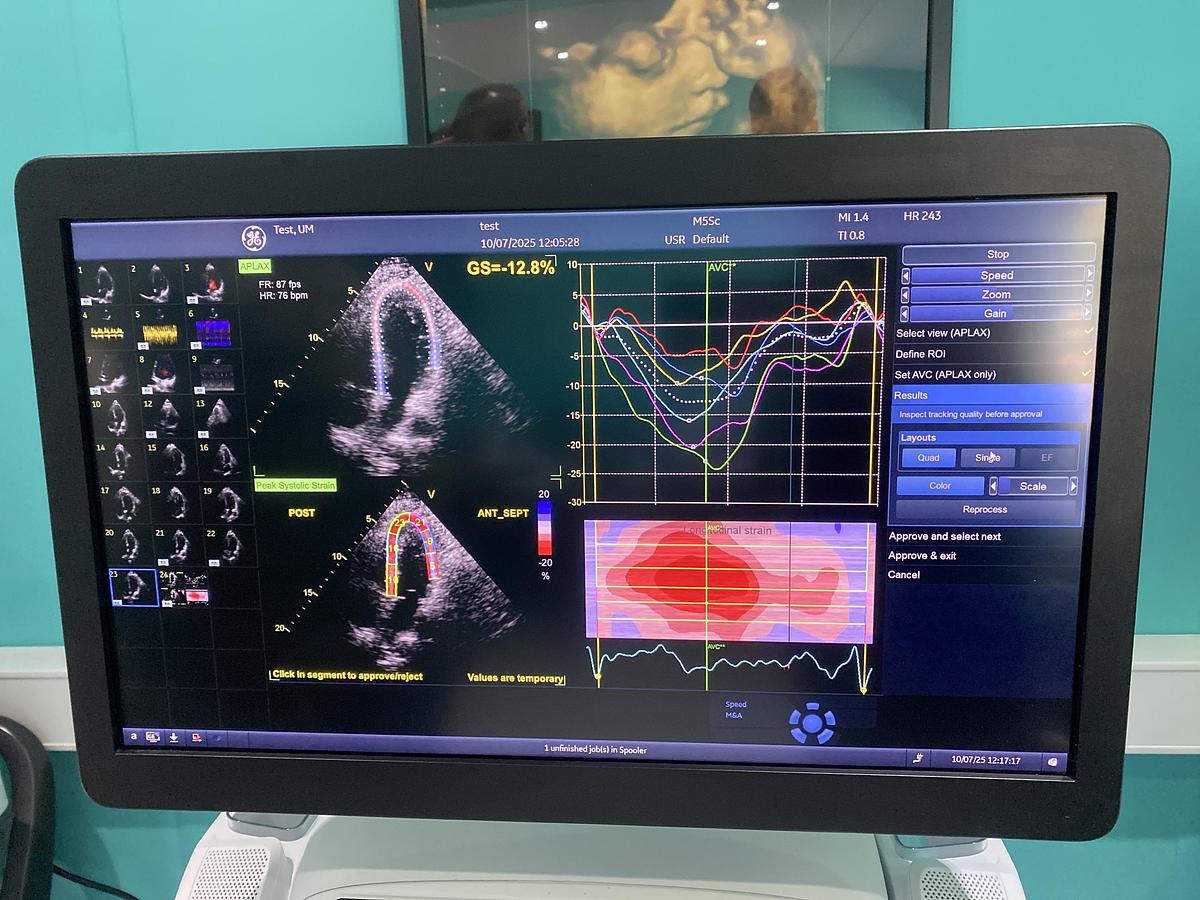 Gebraucht GE Vivid E95 V204 Ultraschallgerät mit M5Sc-D Kardiosonde