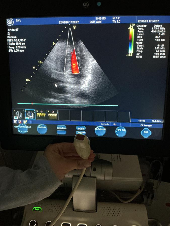Gebraucht GE 10S-RS Kardio Ultraschallsonde