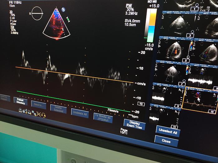 Gebraucht Philips iE33 Ultraschallgerät mit eine X5-1 Sonde