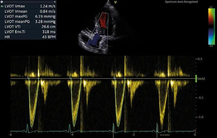 Überholt GE Vivid iq tragbares kardiologisches Ultraschallgerät