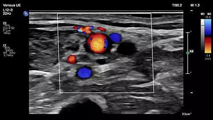 Refurbished Philips Affiniti 50 Farbdoppler Ultraschallgerät