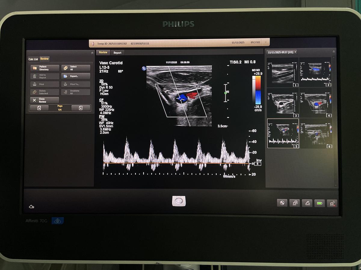Gebraucht Philips L12-3 Linear Ultraschallsonde 