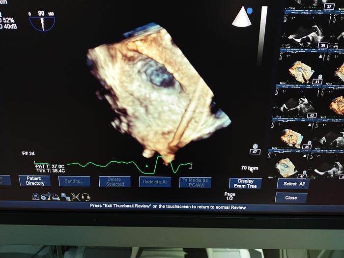 Gebraucht Philips iE33 Ultraschallgerät mit eine X5-1 Sonde