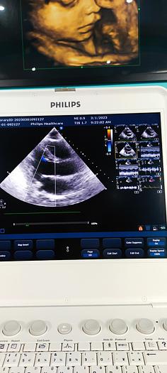 Gebraucht Philips CX50 Ultraschallgerät mit Sektor Sonde SW 2.5.1