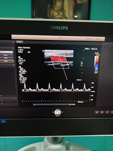 Gebraucht Philips L18-5 Ultraschallsonde 