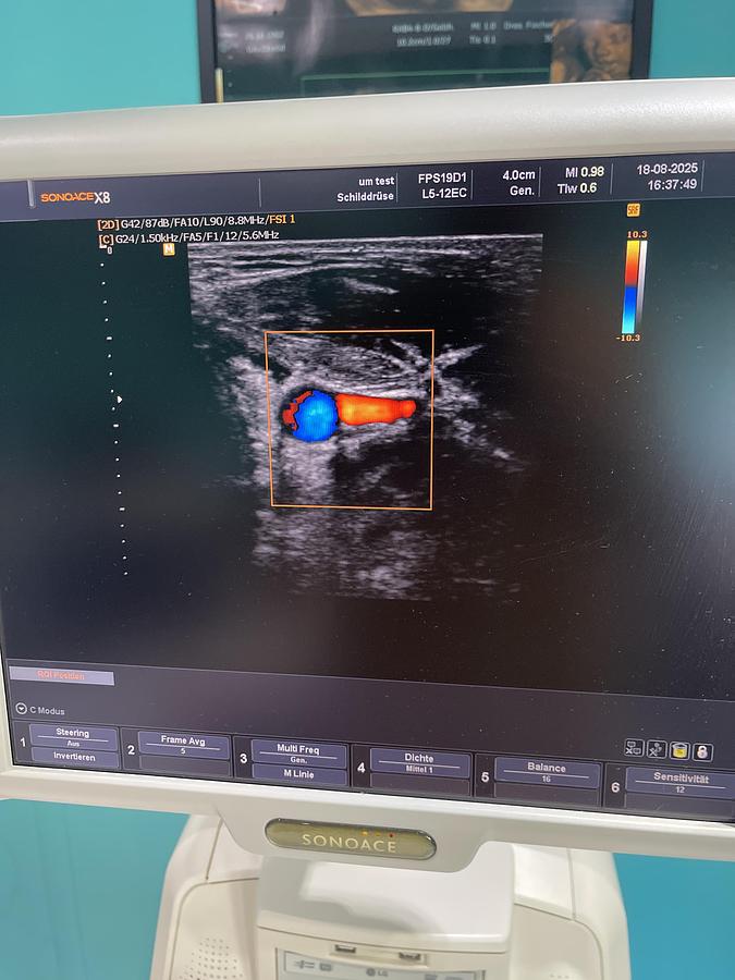Gebraucht SonoAce X8 Ultraschallgerät mit drei Sonden und Drucker