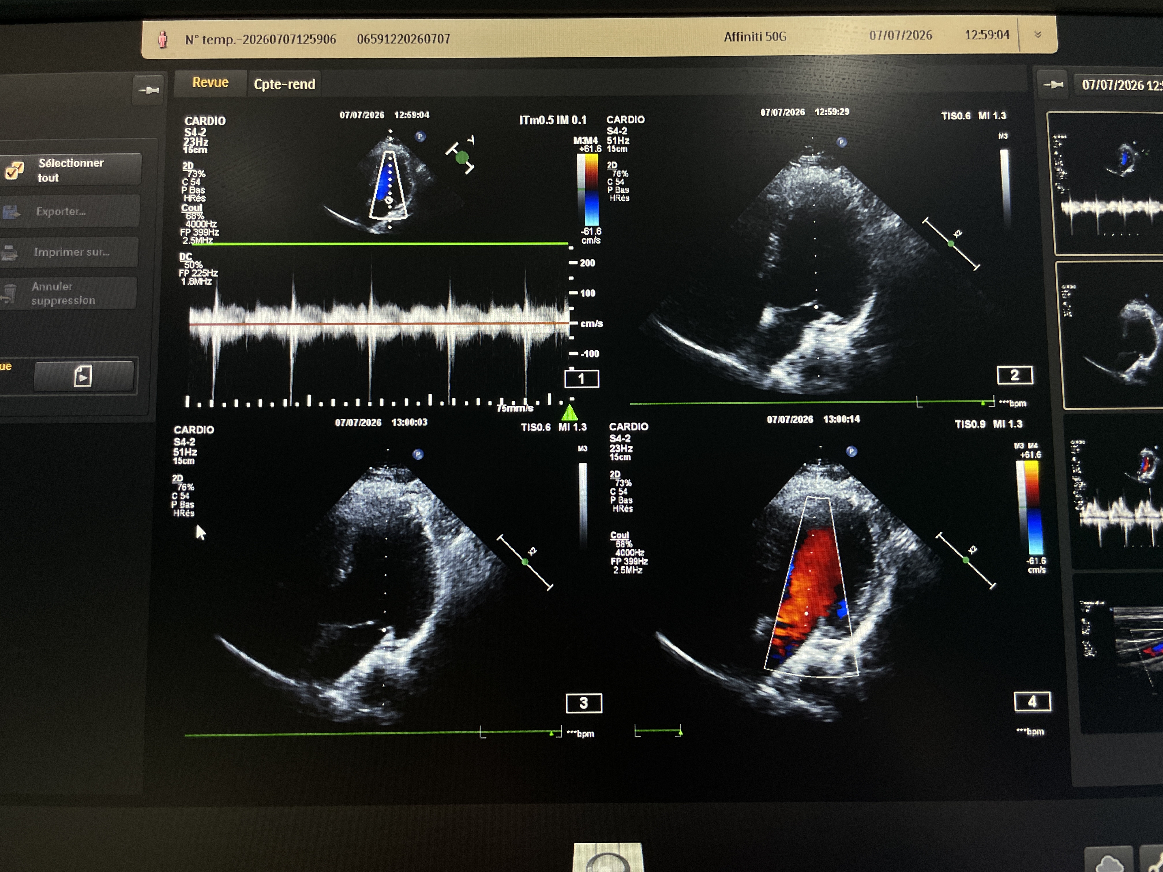 Gebraucht Philips S4-2 Kardio Ultraschallsonde