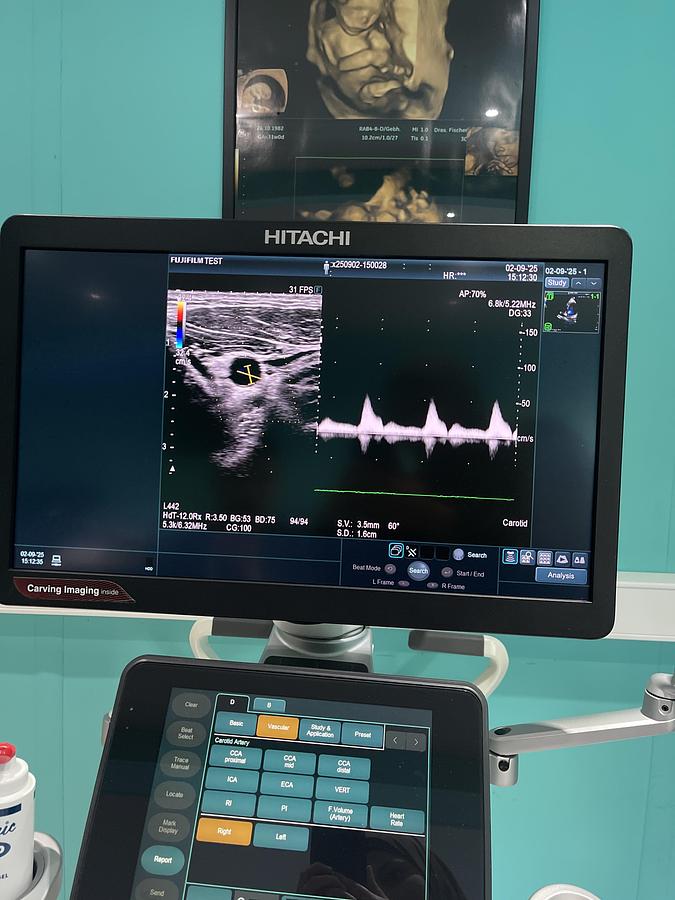 Gebraucht Hitachi ALOKA Arietta 850 Ultraschallgerät mit zwei Sonden und Drucker