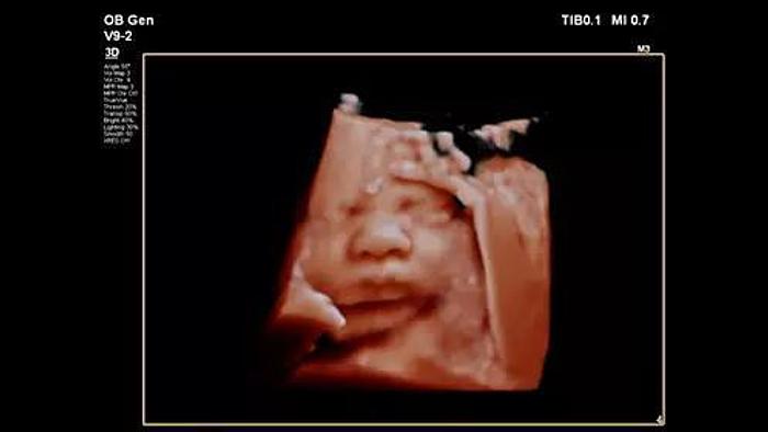 Refurbished Philips Affiniti 50 Farbdoppler Ultraschallgerät