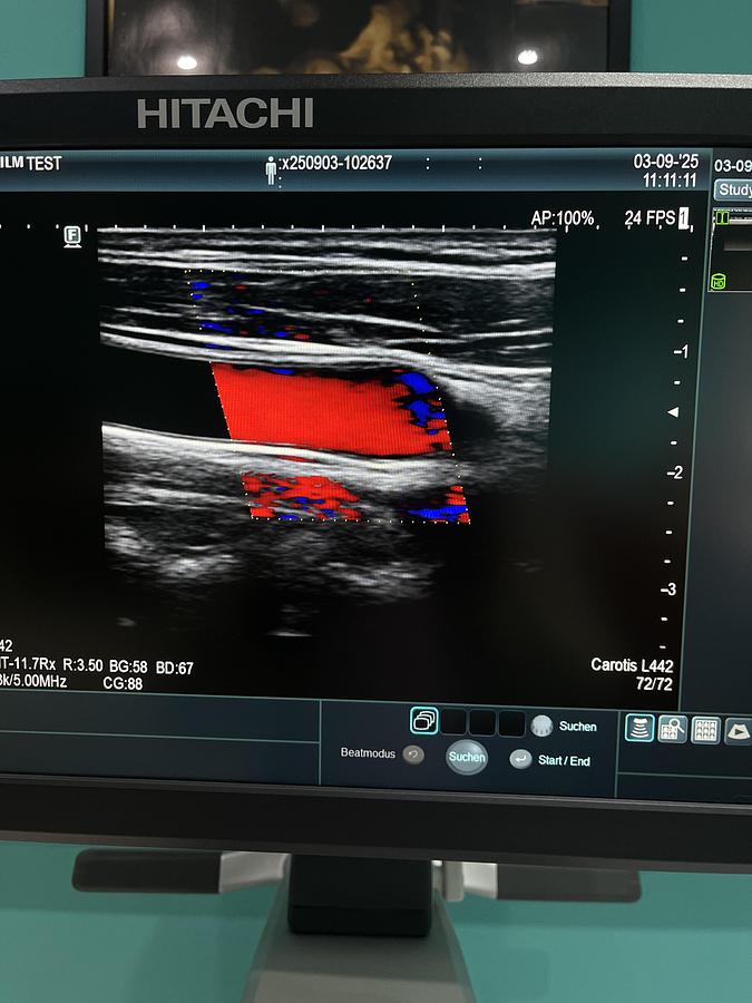 Gebraucht Hitachi ALOKA Arietta 65 Ultraschallgerät mit zwei Sonden