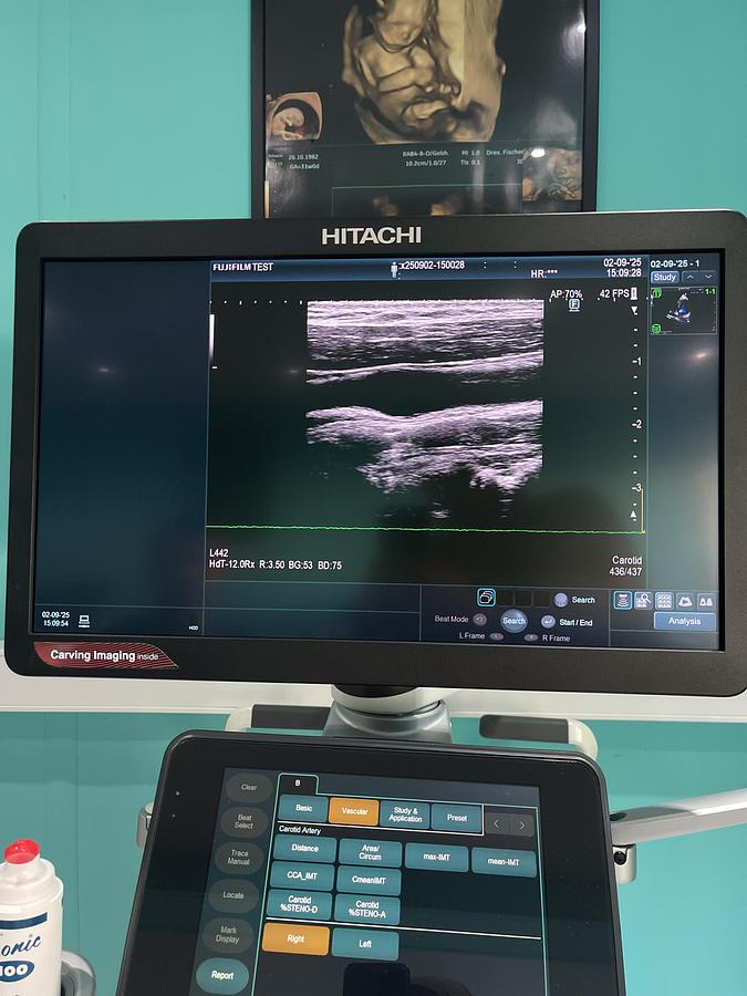 Gebraucht Hitachi ALOKA Arietta 850 Ultraschallgerät mit zwei Sonden und Drucker