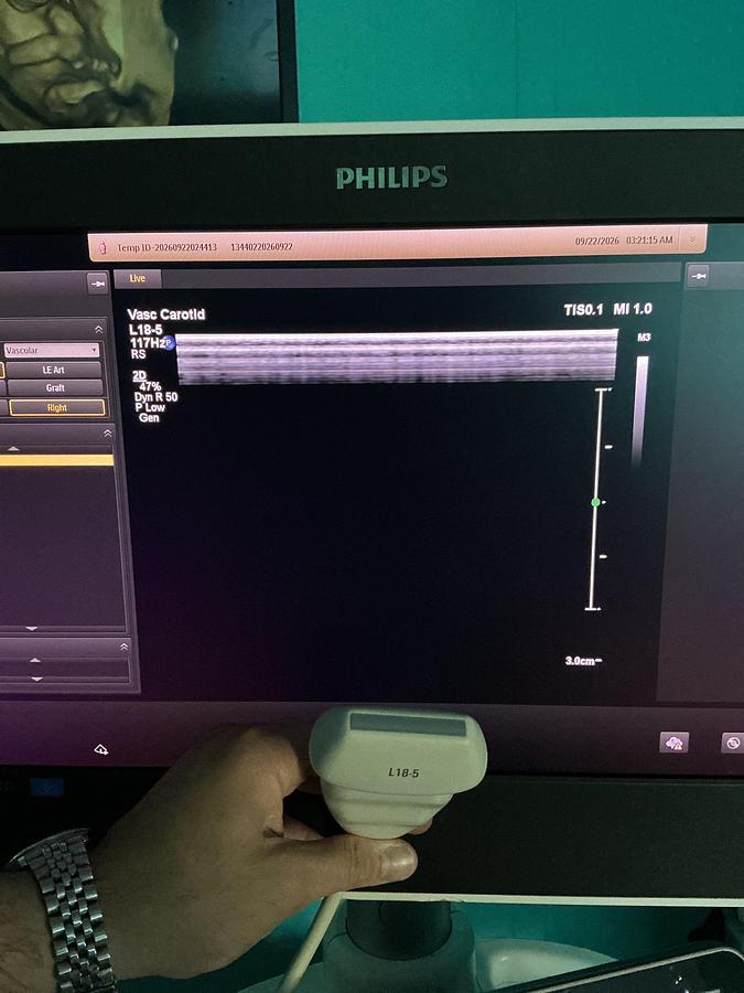 Gebraucht Philips L18-5 Linear Ultraschallsonde