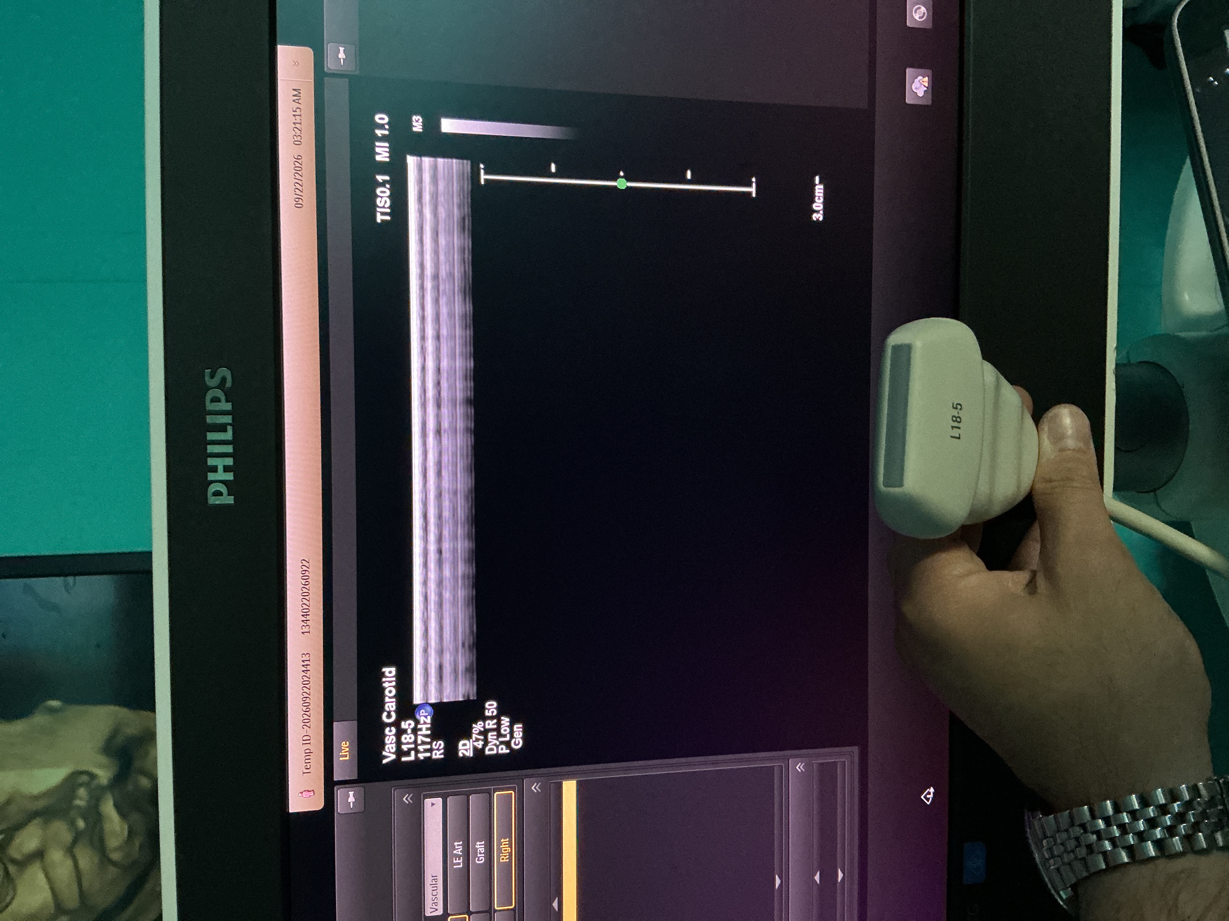 Gebraucht Philips L18-5 Linear Ultraschallsonde