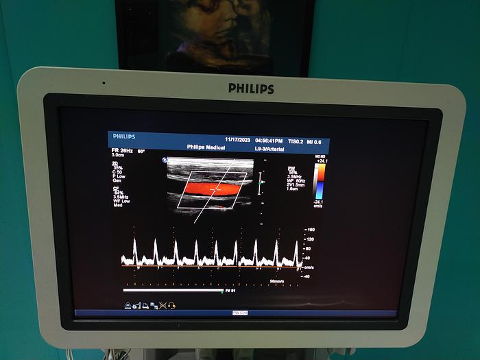Gebraucht Philips iE33 Ultraschallgerät mit eine X5-1 Sonde