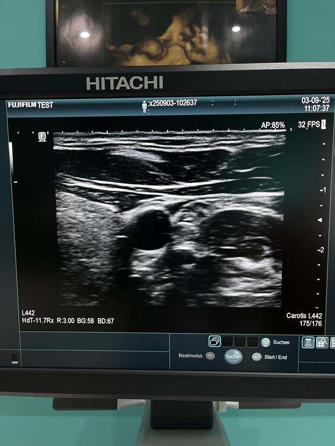 Gebraucht Hitachi ALOKA Arietta 65 Ultraschallgerät mit zwei Sonden