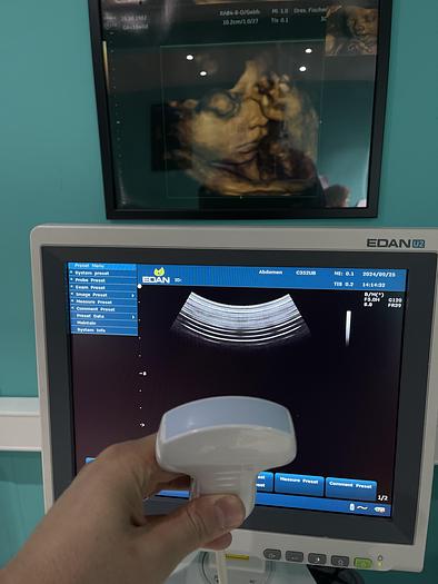 Used EDAN U2 Ultraschallgerät mit drei Sonden und Drucker
