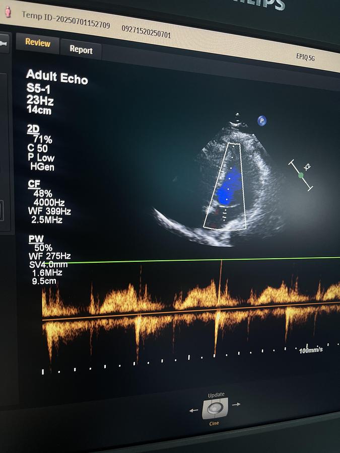 Gebraucht Philips EPIQ 5G Elite B Version Ultraschallgerät mit zwei Sonden