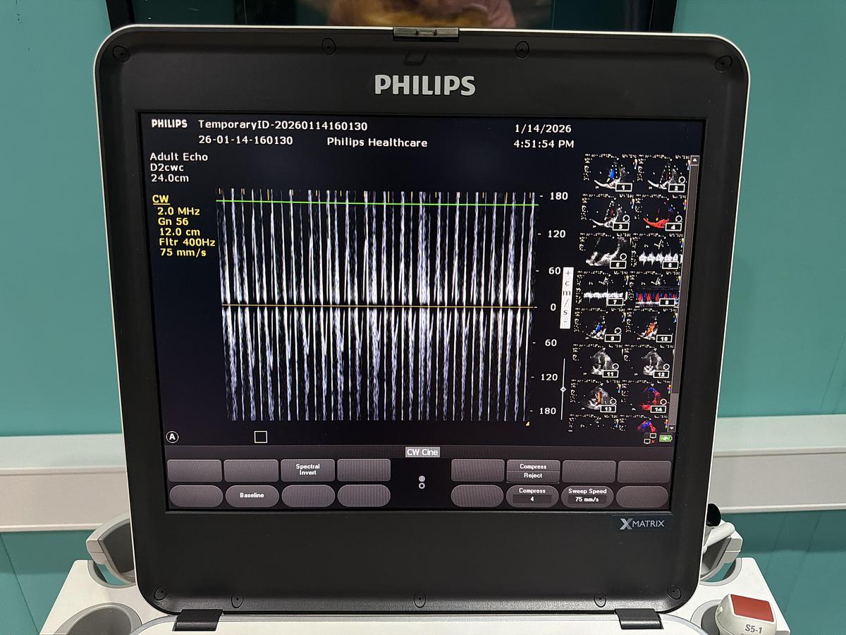 Gebraucht Philips CX50 XMATRIX HW E.0 SW 5.5.3 Ultraschallgerät mit zwei Sonden
