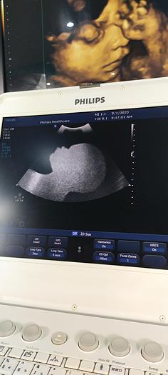 Gebraucht Philips CX50 Ultraschallgerät mit Konvex Sonde SW 2.5.1