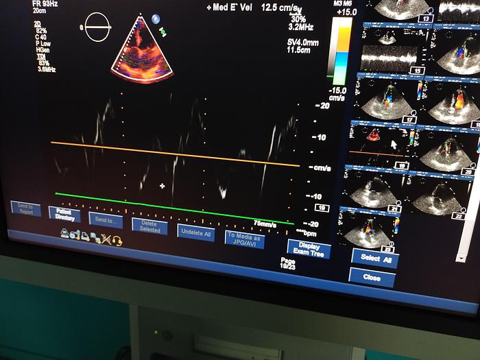 Gebraucht Philips iE33 Ultraschallgerät mit eine X5-1 Sonde