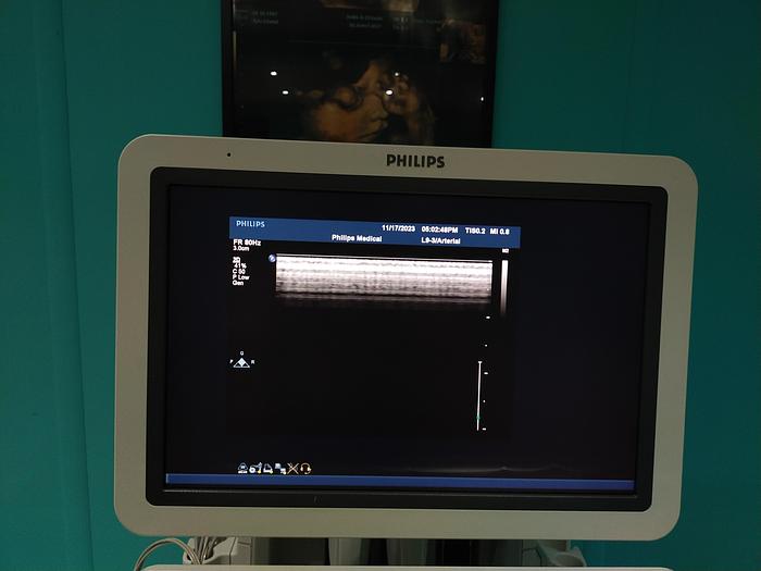 Gebraucht Philips iE33 Ultraschallgerät mit eine X5-1 Sonde