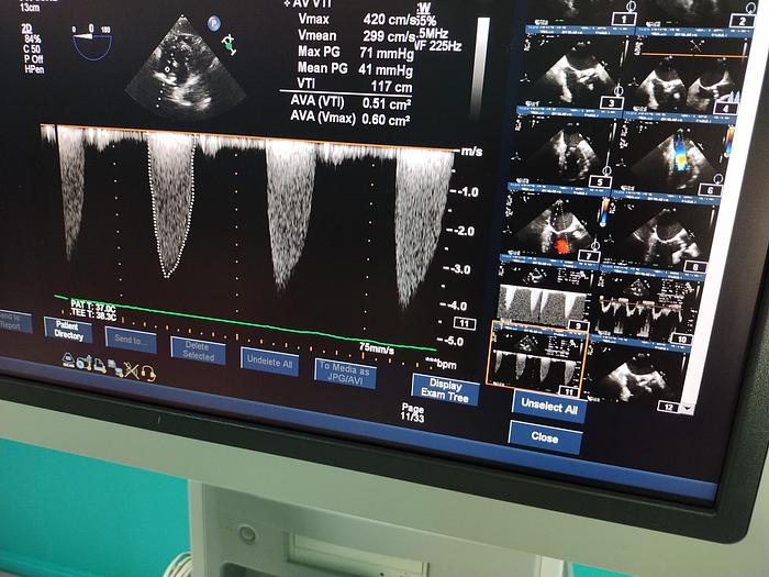 Gebraucht Philips iE33 Ultraschallgerät mit eine X5-1 Sonde