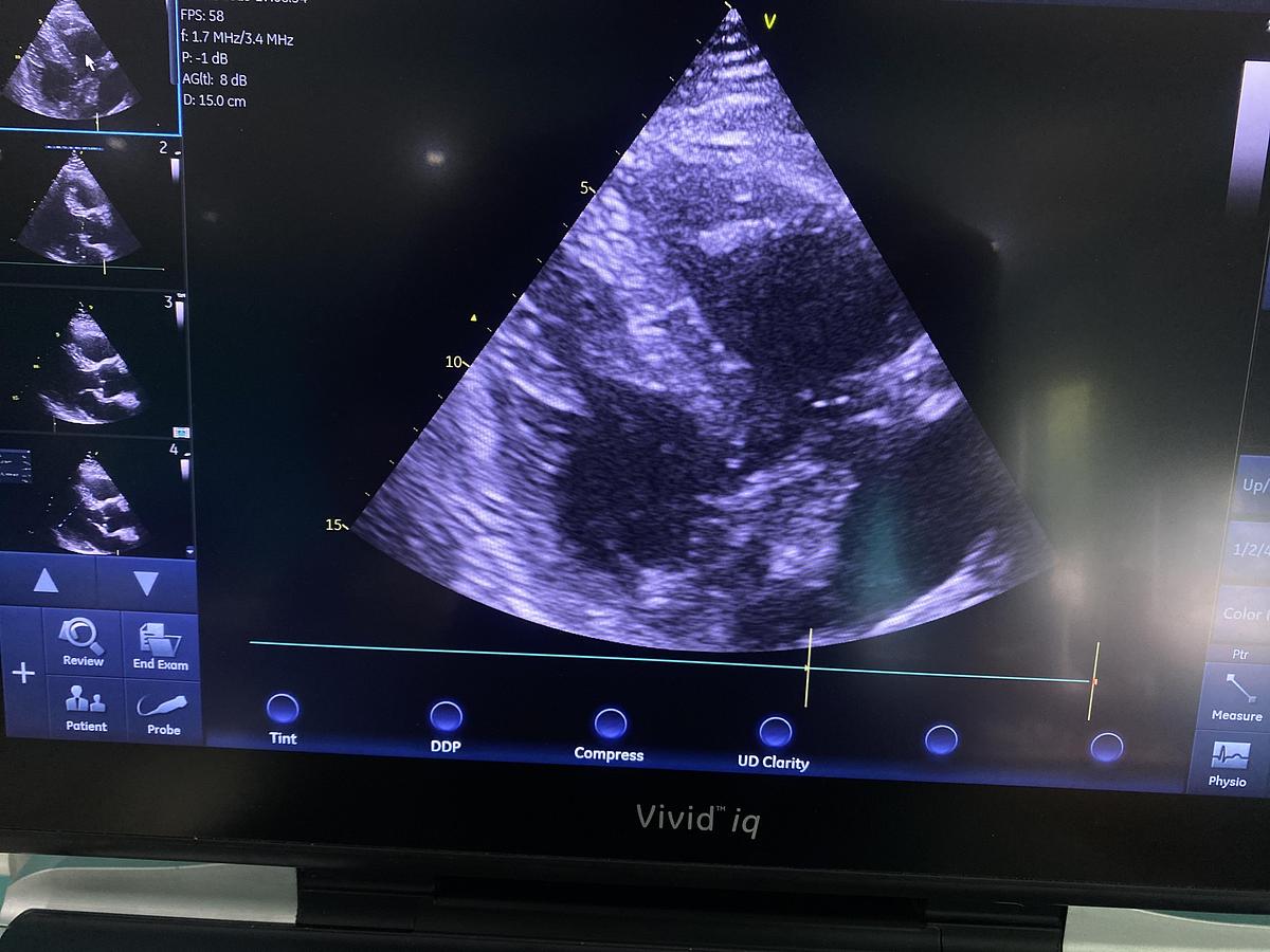 Gebraucht GE Vivid iq Ultraschallgerät mit M5Sc-RS Kardiosonde