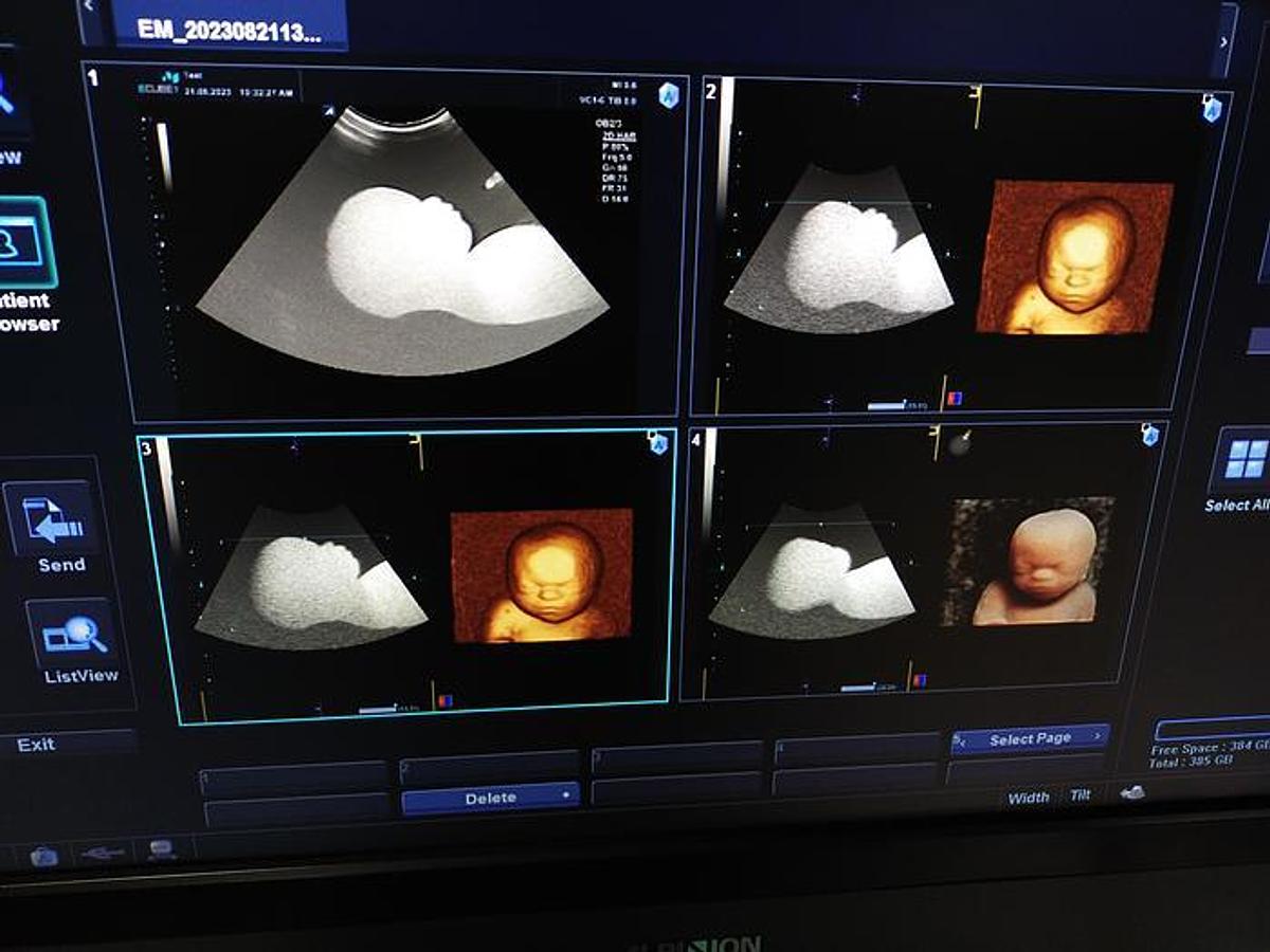 Gebraucht Alpinion SVC1-6 3D/4D Ultraschallsonde