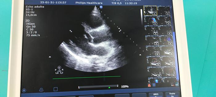 Gebraucht philips ultrasound cx50 mit 2 Sonde linear und sektor