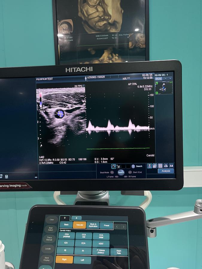 Gebraucht Hitachi ALOKA Arietta 850 Ultraschallgerät mit zwei Sonden und Drucker