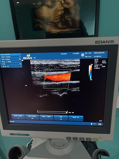 Used EDAN U2 Ultraschallgerät mit drei Sonden und Drucker