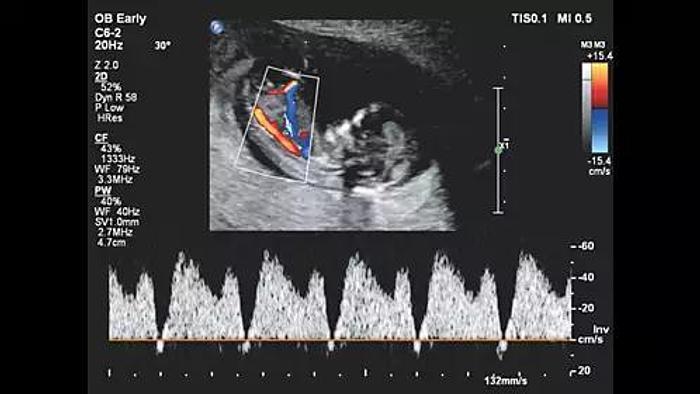 Philips Affiniti 30 Farbdoppler Ultraschallgerät