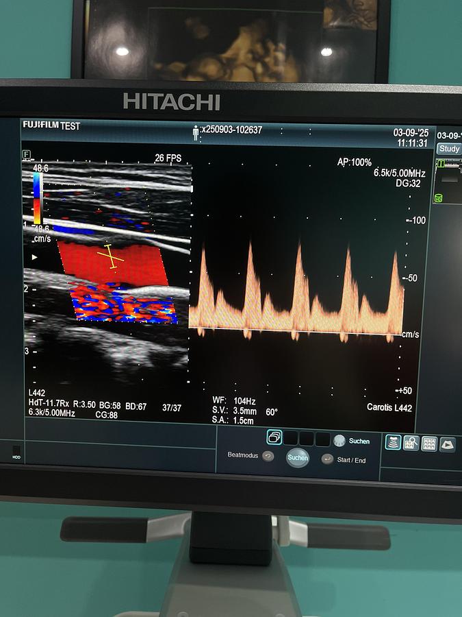 Gebraucht Hitachi ALOKA Arietta 65 Ultraschallgerät mit zwei Sonden